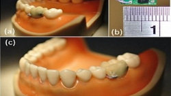 Sensor dental para dejar de fumar